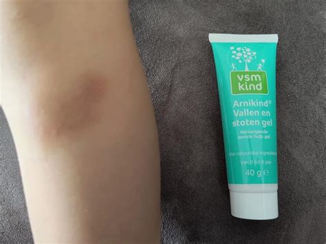 Review Arnikind Vsm Vallen En Stoten Gel Bij Blauwe Plekken