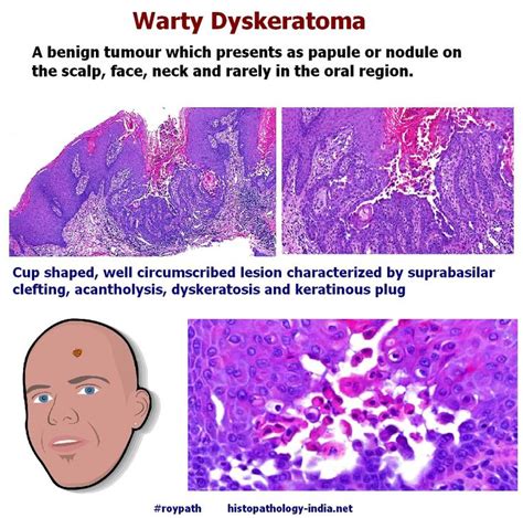 Pathology Of Warty Dyskeratoma Focal Acantholytic Dyskeratosis Basal Cell Carcinoma