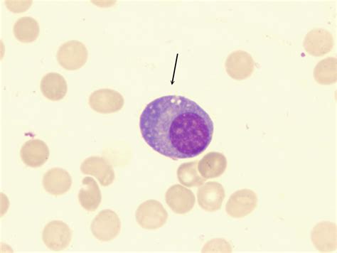 Bone Marrow Nonneoplastic Plasma Cells