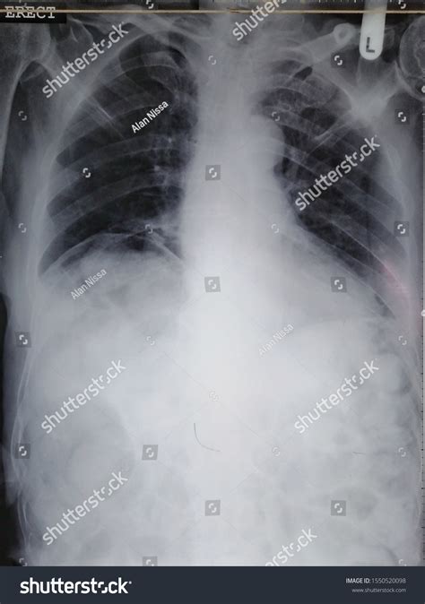 Chest Xray Showed Air Under Diaphragm Stok Fotoğrafı 1550520098