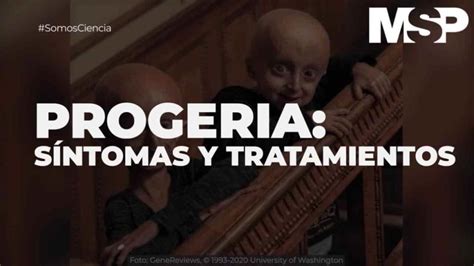 Progeria Síntomas Y Tratamientos