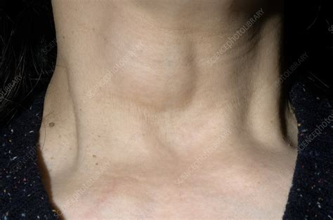 Thyroid Cyst Stock Image M1300911 Science Photo Library