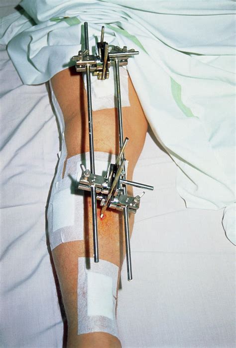 Metal Frame Attached To A Patients Broken Leg Photograph By Garry