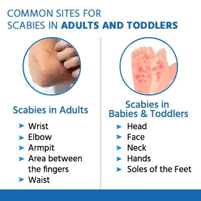 Scabies Symptoms Causes Prevention Treatment