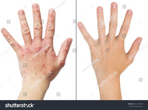 Real Photo Girls Hand Patient Eczema Stock Photo 441723403 Shutterstock