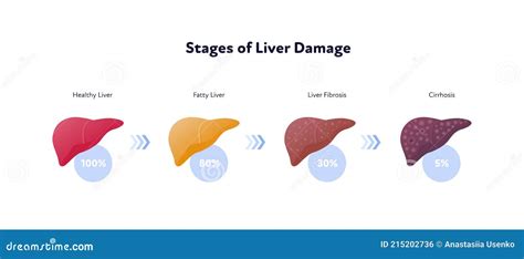 Liver Damage Infographic Vector Flat Illustration Anatomical Human