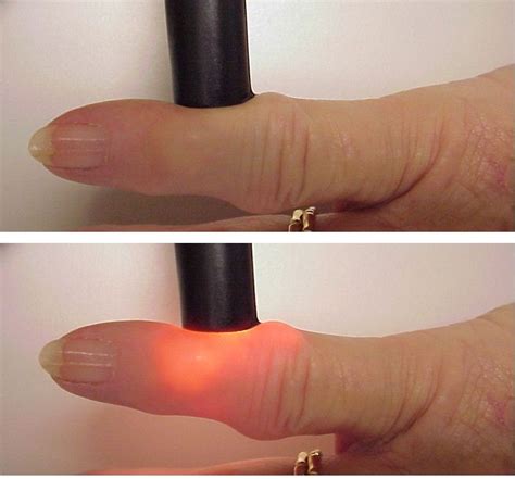 The 25 Best Ganglion Cyst Removal Ideas On Pinterest Home Remedies