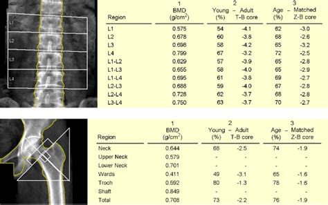 Bone Mineral Density Of L Spine And Left Femur Neck Shows Osteoporosis