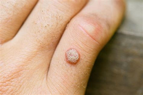Cutting Off A Wart Safe And Effective Removal Advice