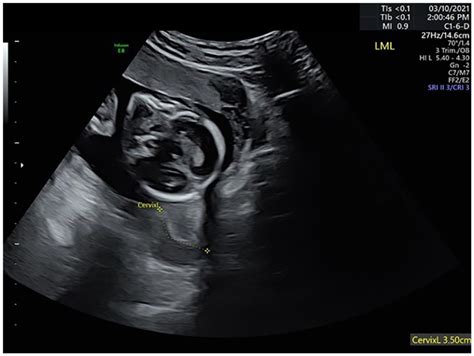 Comparison Of Transabdominal And Transvaginal Sonograms In Evaluation