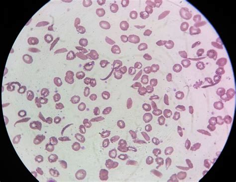 Anemia Falciforme4 Lab Prática