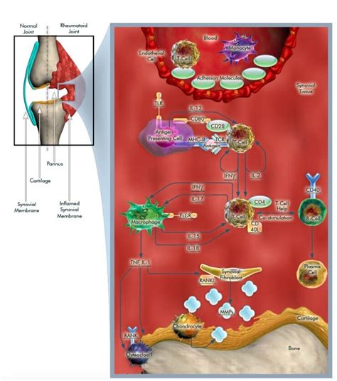 Pathogenesis Of Rheumatoid Arthritis Thermo Fisher Scientific Us