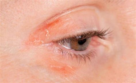 Dry Skin Around Eyes Or Eyelids Causes And Treatments Skincarederm
