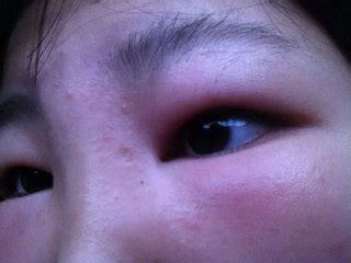 アレルギー 目 腫れ | 朝起きたら突然目が腫れている!鏡を見て ...