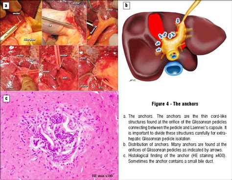 Figure 4 From Standardization Of Anatomic Liver Resection Based On