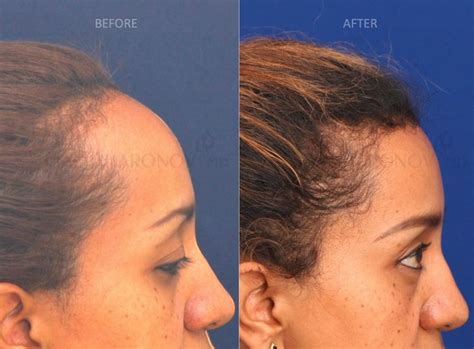 Forehead Reduction Surgery Hairline Lowering Surgery Before And After