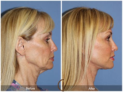 Dr Kevin Sadati Releases Tip Sheet On Facelift Vs Neck Lift When A