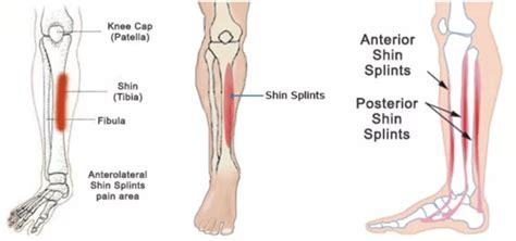 Shin Splints Treatment And Prevention Stable Massage