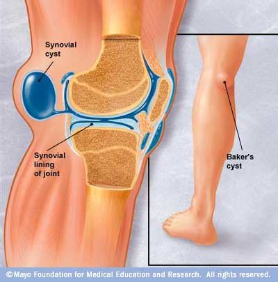 Symptoms and signs that accompany knee pain include redness, swelling, and difficulty walking. Baker's Cyst, Knee Pain and New Treatment Options ...