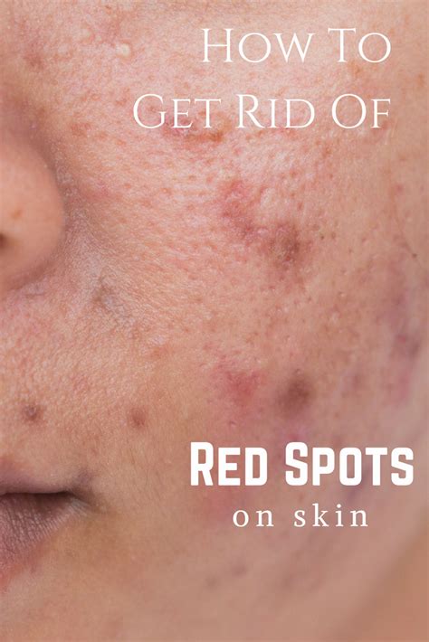 Red Acne Spots On Face Home Remedies Wererabbits