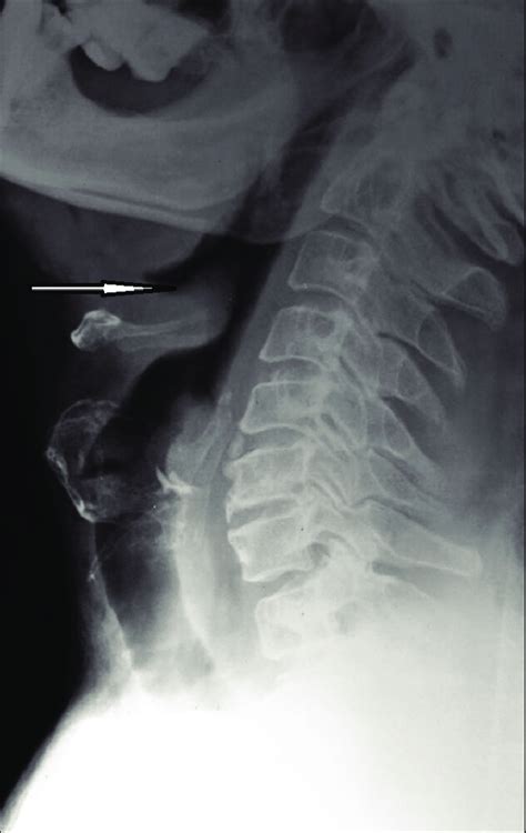 Plain X Ray Of The Neck Lateral View Showing A Swollen Epiglottis
