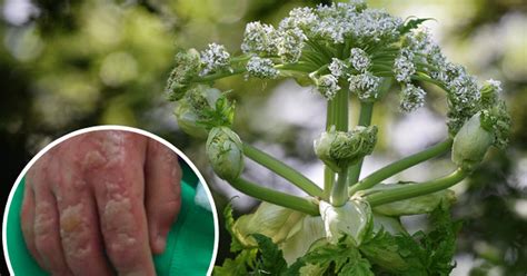 Toxic Plant That Can Cause Blindness And Burns Spotted In Bath