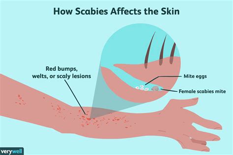 Itch Itchy Spirit Scabies Effects Malnutrition Sore Scabies Nodules