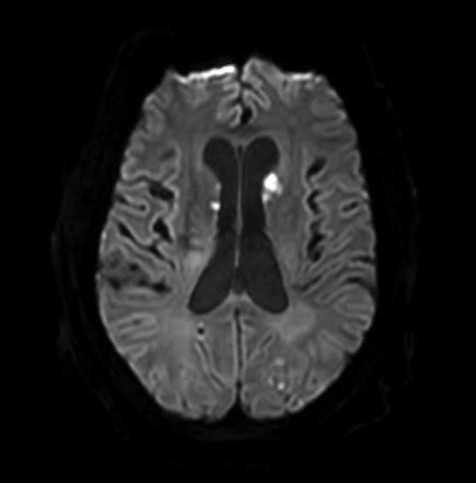 Multiple Cerebral Emboli From Caseous Necrosis Of The Mitral Annulus