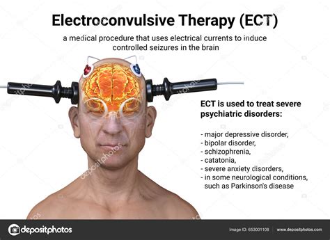 Electroconvulsive Therapy Ect Treatment Used Severe Mental Illnesses