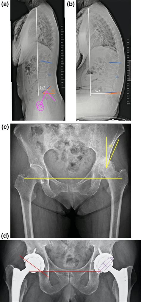 illustration of the radiographic measurements the pelvic incidence download scientific diagram