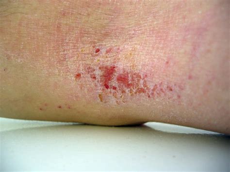 Eczema Herpeticum Symptoms Diagnosis And Treatment