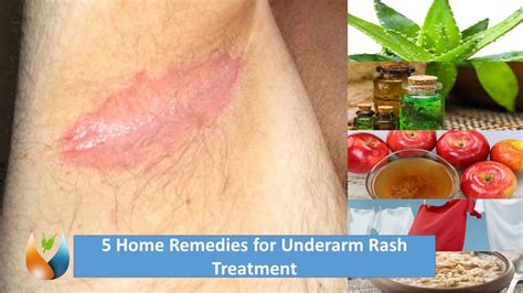 Home Remedy For Itchy Underarm Rash Bruin Blog