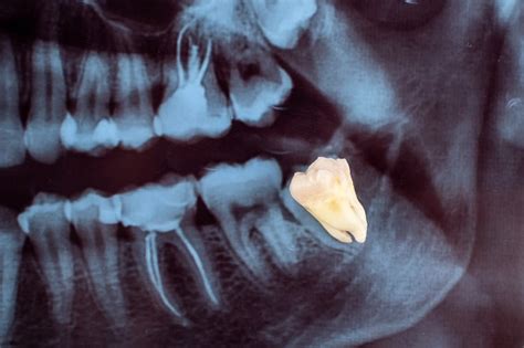 Healing From Wisdom Tooth Extraction Ismile Dental Spa Carmichael