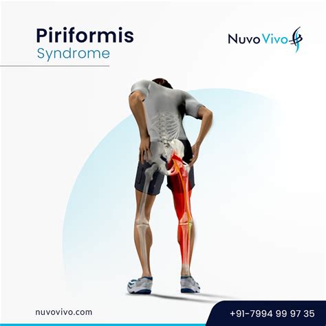 Piriformis Syndrome Nuvovivo