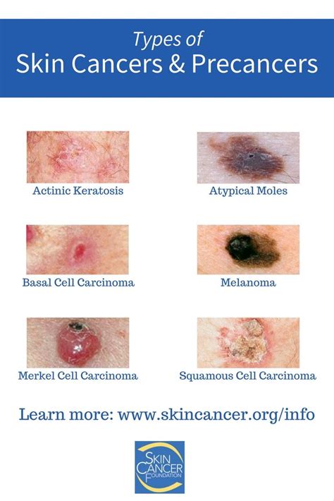 Do You Know All Of The Different Types Of Skin Cancers And Precancers