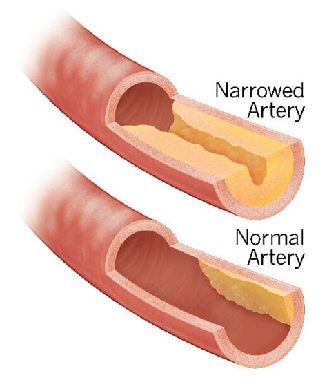Narrowed Artery Illustration Coronary Artery Disease Csi360