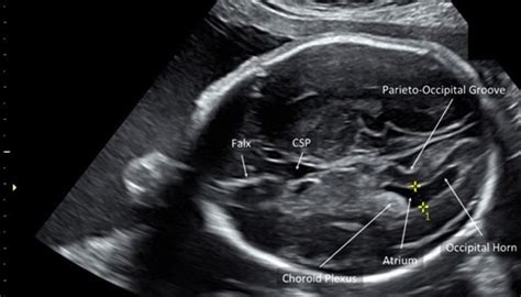Mild Fetal Ventriculomegaly Diagnosis Evaluation And Management