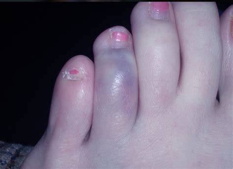 Blue Toe Syndrome Symptoms Treatment Causes Pictures