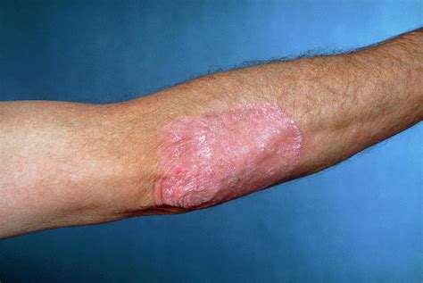 Ordinary Photo Showing Psoriasis On Elbow Photograph By James Stevenson