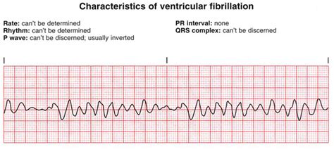 Ventricular Fibrillation Heart Rhythms Rhythms Pr Interval