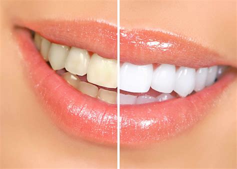 Mayo Clinic Q And A Many Safe Choices Available To Help Whiten Teeth