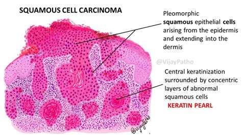 Pathology Of Squamous Cell Carcinoma Pathology Made Simple