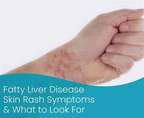 Fatty Liver Disease Skin Rash Symptoms And What To Look For