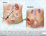 Kidney Recovery After Dialysis Pictures