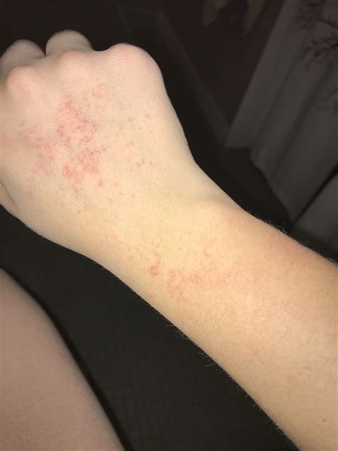 Rash On Hands What Is It Zohal