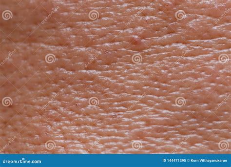 Male Face Oily Skin Large Pores With Acne Macro Shot 库存图片 图片 包括有 详细资料