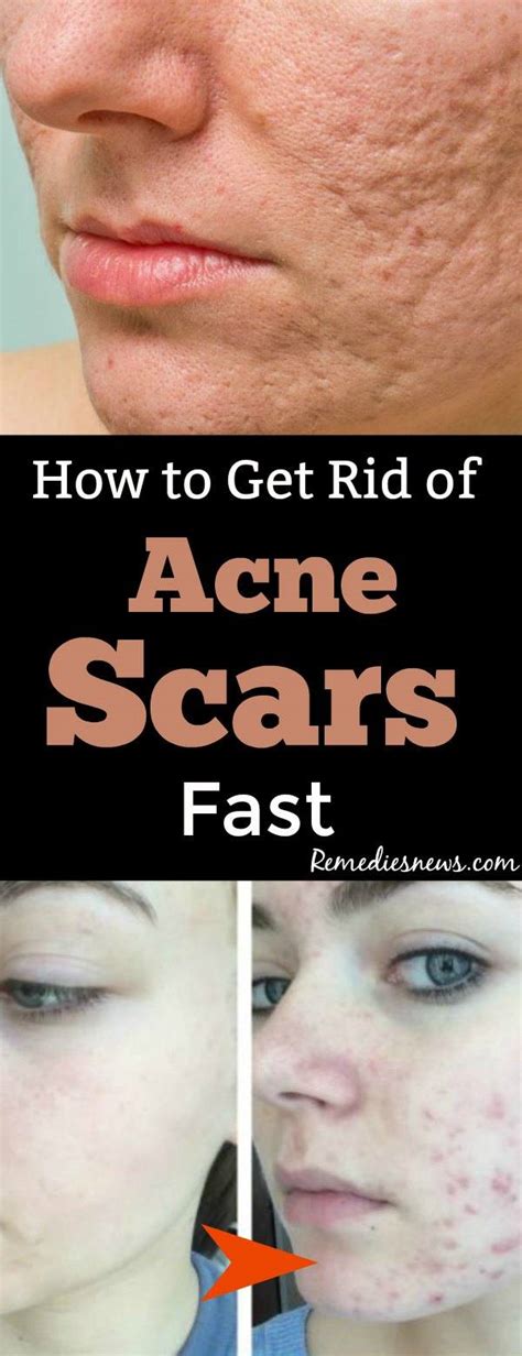 How To Get Rid Of Acne Scars Fast 9 Best Home Remedies