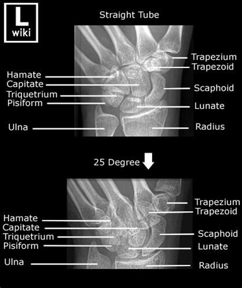 Radiographic Anatomy Wrist Scaphoid Radiographic Anatomy