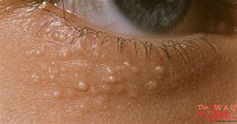Heres Why Some People Have Those Weird White Bumps Around Their Eyes