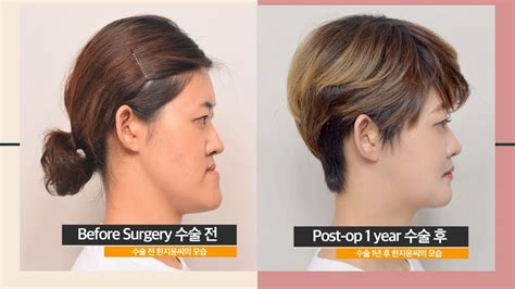 Prognathism Lantern Jaw Corrected By Double Jaw Surgery Surgery